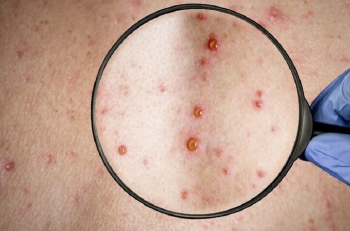 Brasil registra terceiro caso de varíola dos macacos